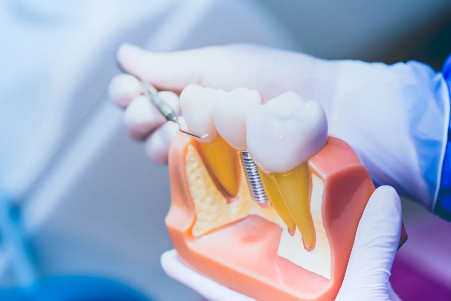 Zabiegi dentystyczne refundowane przez NFZ