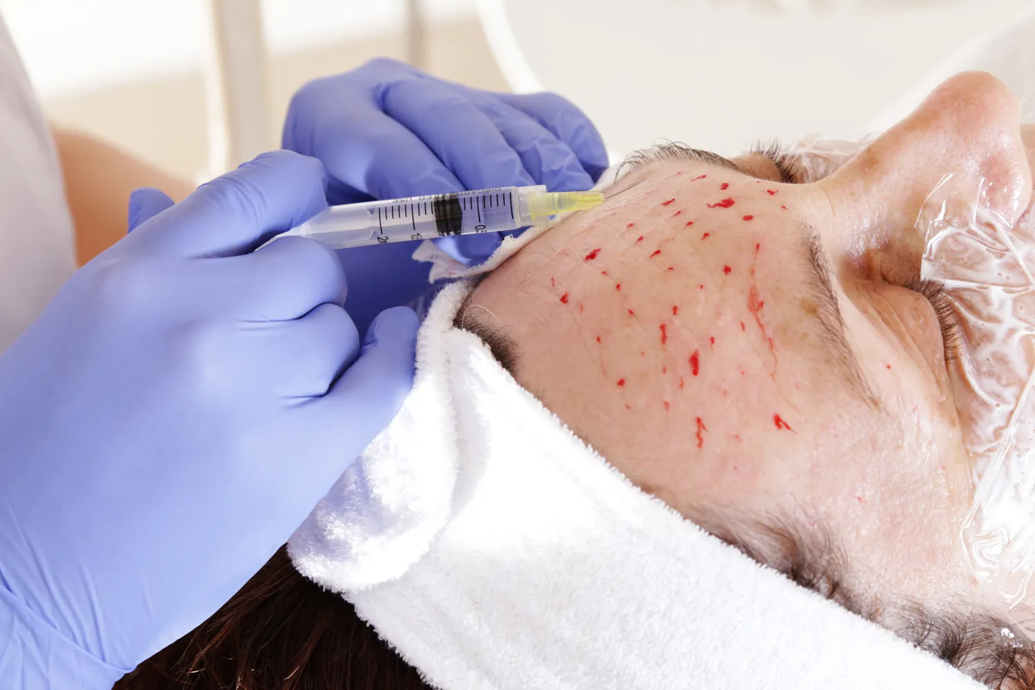 Gdzie kupić kwas hialuronowy w strzykawce?