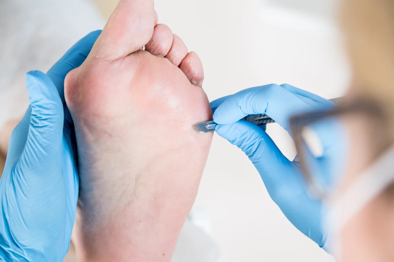 Dobry podolog radzi - wrastanie paznokcia