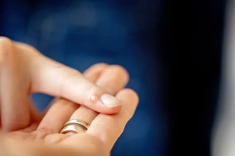 Jak domowym sposobem usunąć kurzajki?